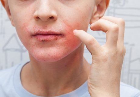 Boy scratching his face. Human skin, presenting an allergic reaction, allergic rash on face and lips. Health care and medicine concept.